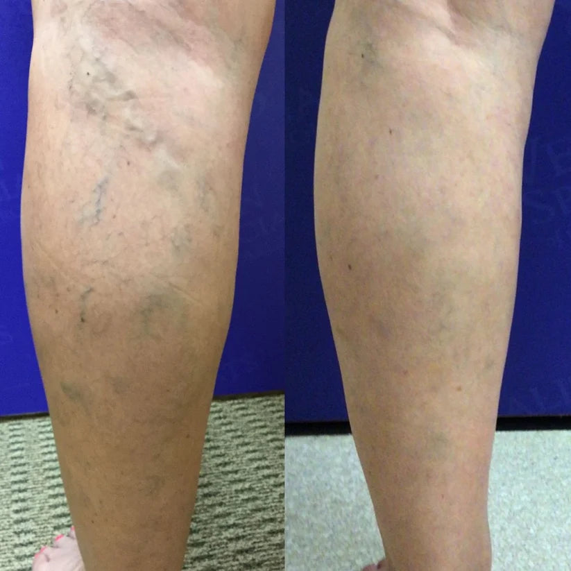 VariCream - Crema reductora de varices, para dolor y piernas hinchadas